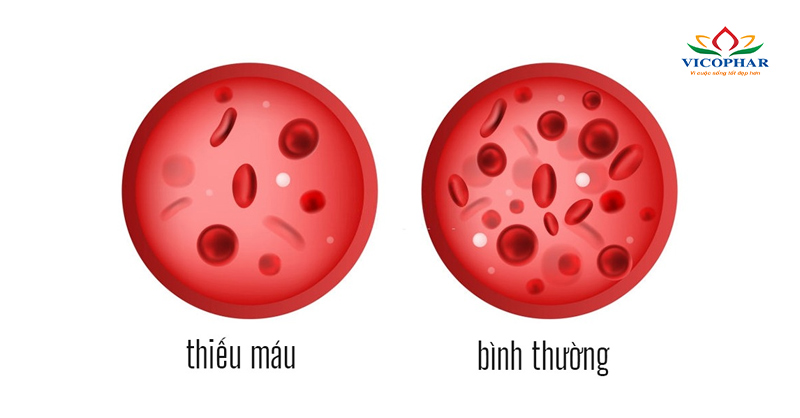 Thiếu máu thiếu sắt là gì
